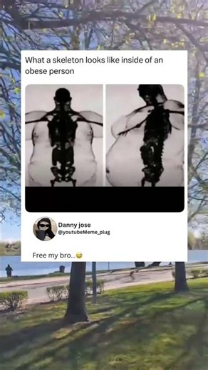 What a skeleton looks like inside of an obese person…