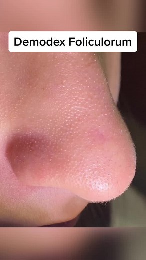 Demodex Foliculorum en la Piel: Síntomas, Tratamiento y Más