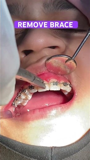Remove Bracket. #composite #dental #orthodontics