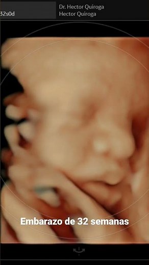 Embarazo de 32 semanas: Ecografia 5D