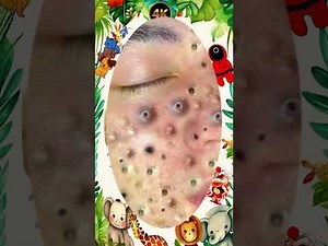 Blackheads Removal #107 | Acne Treatment and Very Satisfying Satisfying Pimple pop #blackheads