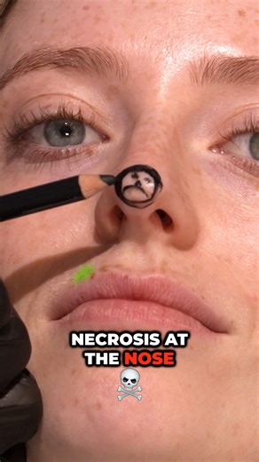 Inject here and you can cause nasal tip necrosis. The connection between the superior labial artery, columellar artery, and the poorly supplied nasal tip means an occlusion may affect both the tip and the anterior septum. If you don’t understand the full arterial pathway, you risk under-diagnosing and under-treating. Anatomy makes you a safer injector. Comment ANATOMY to join my webinar tonight at 8pm UK / 3pm EST. | Dr Tim Pearce