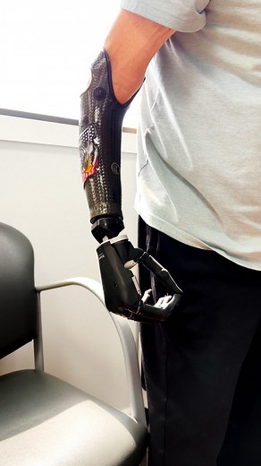 Check out Joe’s impressive control with his new myoelectric prosthesis! 🦾🤩 @ossur I-Limb 🦾 #upperextremityprosthetics #prostheticarm #amputee #bionicarm | A Step Ahead Prosthetics