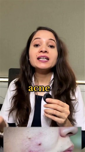 Comment “ACNE” to get the detailed holistic acne treatment guide