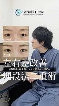 二重整形で目の左右差を改善｜長野市で埋没法・切開法による二重術ならウェンデルクリニック #美容 #美容整形 #二重術 #埋没法 #切開法 #長野市