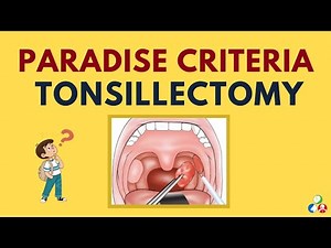 Paradise Criteria for Tonsillectomy | ENT Viva Voce