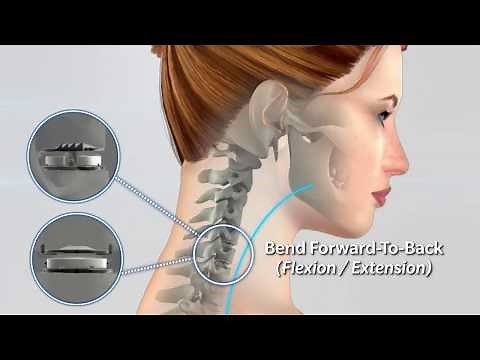 Mobi-C Artificial Disc Replacement vs. ACDF Spine Fusion Surgery