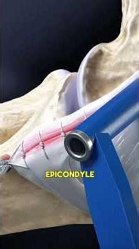 Medial Ulnar Ligament Repair (3D Animation) #3danimation #medicaleducation #healthcare #fyp