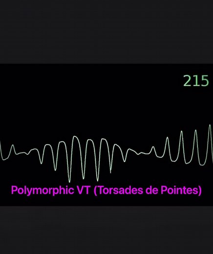 🔰Animation showing how a R-on-T PVC can lead to sustained Torsades and then, eventually VF!🔰 🔗 Struggling with EKG rhythms interpretation ? Learn & Practice and test your knowledge here 👉 https://aprnworld.com/basic-arrythmia-recognition-course/ 🔗 Learn advanced arrhythmia course with ANCC Accredited CE Credits 👉 https://aprnworld.com/advanced-arrhythmia-with-ce-and.../ 🔗 Get a CE Course, CE Tracker & an EKG Book for free 👉 https://aprnworld.com/free-download/ #ceus | EKG Central