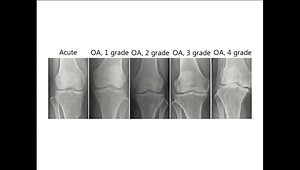 Injection Therapy for Knee OA