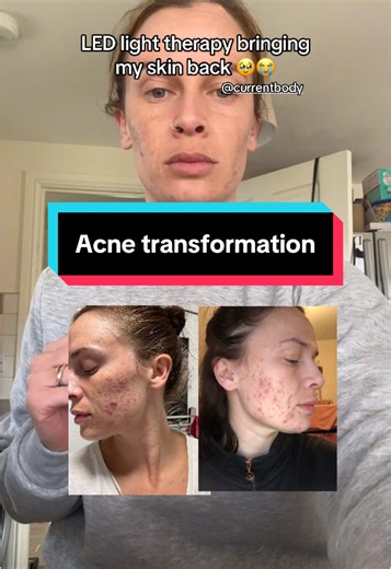Transform Your Skin with Current Body LED Light Therapy