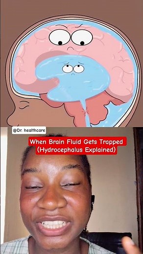 Why Some Babies Develop ‘Water in the Brain’ 🧠 #diseplee ‪@Dr_Healthcare1‬