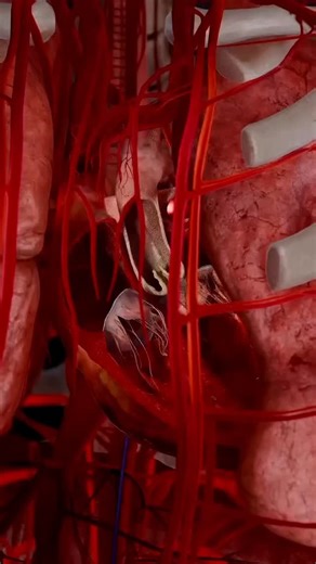 medical_animation on Instagram: "How does the TAVI procedure help treat aortic valve stenosis? Part 2 For those diagnosed with aortic valve stenosis, TAVI (Transcatheter Aortic Valve Implantation) offers a minimally invasive solution. Unlike traditional open-heart surgery, TAVI involves placing a new valve inside the damaged one through a catheter, usually inserted via the femoral artery. This revolutionary procedure reduces recovery time, making it a game-changer for patients who may not be eli