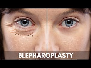 Blepharoplasty Procedure