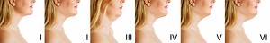 Mini Neck Philadelphia | Neck Line Rejuvenation Wayne | Mini Neck Lift