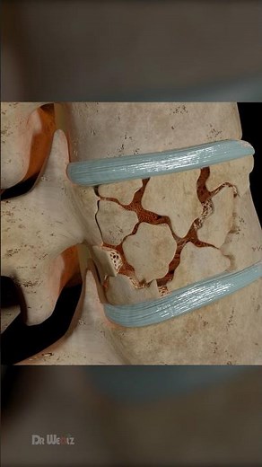 Bone Cement Injection: 3D Animation