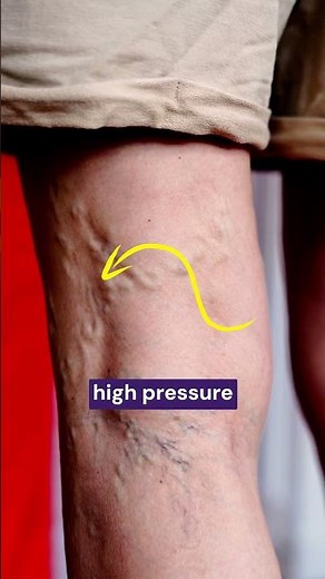 Does CVI thin the Skin?