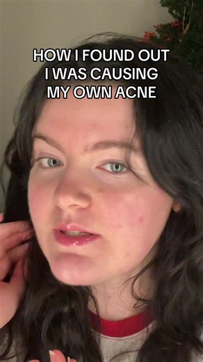 Addressing Acne: Finding the Right Skincare Products