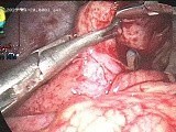 Complicated Appendix Reduced • Video • MEDtube.net