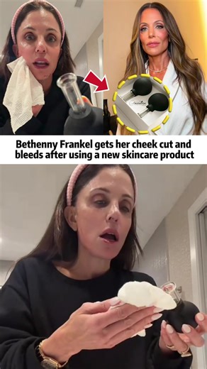 Bethenny Frankel gets her cheek cut and bleeds after using a new skincare product#news #usa #tiktok #fyp