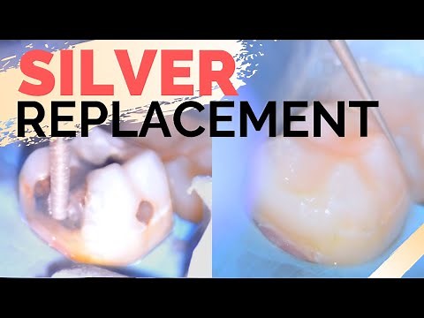 Amalgam Fillings Removal w/ Rubberdam | Replacing Dental Silver Fillings with Composite Resin
