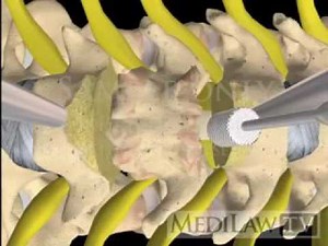 Cervical Spine Vertebrectomy Corpectomy with cage plate orthopeadic 3D animations