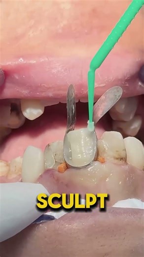 Replacing Old Front Tooth Fillings! 🦷💎 #Dentist #shorts