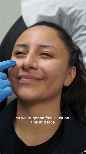 Cheek Filler & Restylane Contour · Rancho Cucamonga