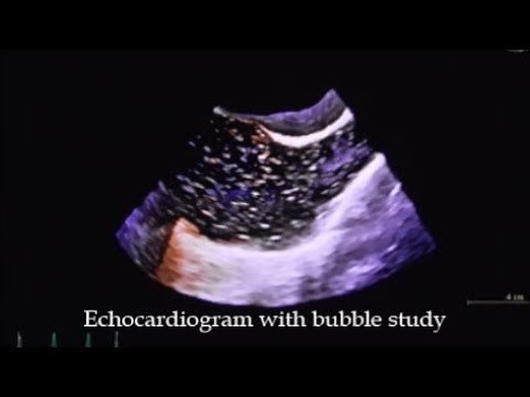 Echocardiogram with bubble study
