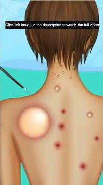 ASMR Remove Big Pustule from the Back and Pimple Popping Acne Animation