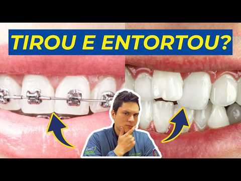Have you ever worn braces? Understand why teeth can become crooked again after orthodontic treatm...