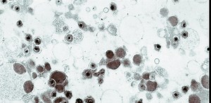Cytomegalovirus lies dormant in most US adults and is the leading infectious cause of birth defects, but few have heard of it