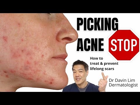 Picking acne | How to treat to prevent lifelong scars
