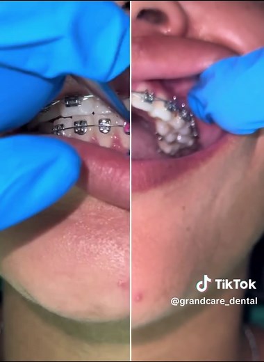 Understanding Orthodontic Headgear: Benefits and Tips