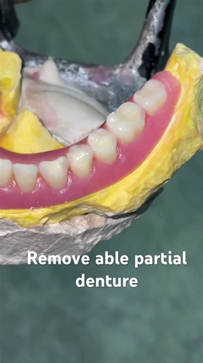 Remove able partial denture 😬😬😬#dentist #apexdental #splittooth #partialdenture #orthodontist