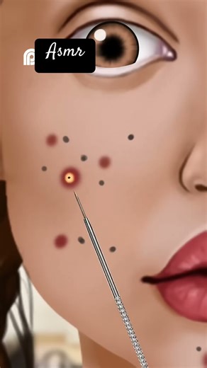 Wow Incroyable sebum extraction #asmr #animation #makeover #makeup