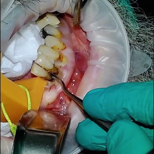 Simple Extractions due to severe periodontal disease