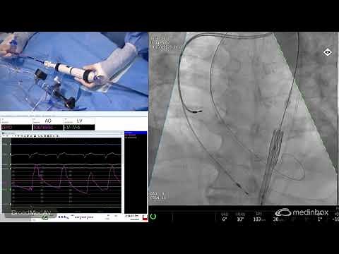TAVI For Severe Aortic Stenosis Using A Sapien 3 Valve