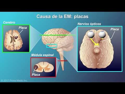 Explanation of multiple sclerosis
