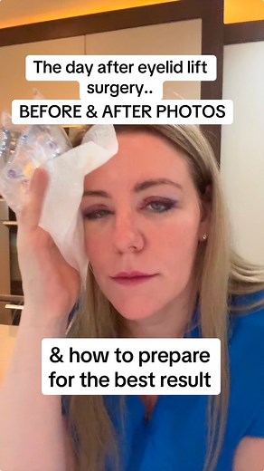 👀 Before & after photos throughout the healing stages following Hooded Eyelid lift surgery (upper Blepharoplasty) and lazy lid ptosis repair (Muller’s muscle Conjunctival Resection). With credit to specialist eye surgeon Dr Ioana Pereni at the Medical Eye Clinic Exeter. I think she has done a fabulous job! What did I do to prepare for this surgery to optimise my result?…1/Did my research. I found a specialist I could truly trust. It’s so important to go to an eye surgeon (ocular plastics) rathe