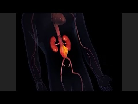 Treating Abdominal Aortic Aneurysms (AAA) with EVAR