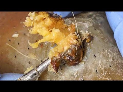 Dr. Lee’s Real-Extraction – Massive Blackhead Satisfaction petal clocks