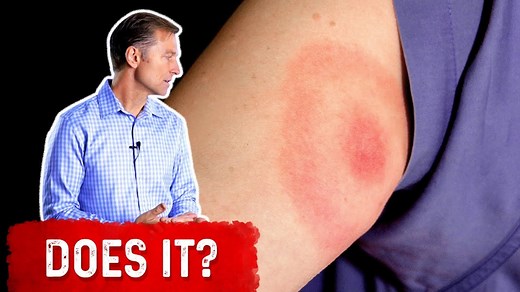 If you have a bullseye rash, is it Lyme disease, or could it be something else? Check this out! | Dr. Eric Berg