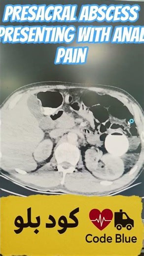 Presacral Abscess Presenting With Anal Pain #emergencyroom #توعية_طبية