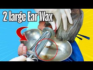 Largest Ear Wax I've Ever seen 🤯 #earwaxremoval #earwaxremoving #earcleaning