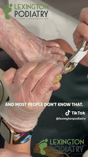 Full video tomorrow on YouTube! #lexingtonpodiatry #podiatry #nails #nail #toenail #toenailremoval