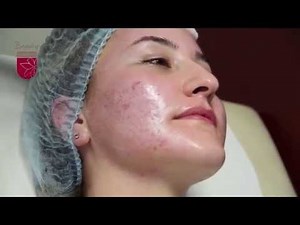 Peeling-ul chimic la Centrul Medical Academica