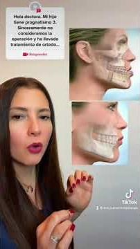 Prognatismo Mandibular