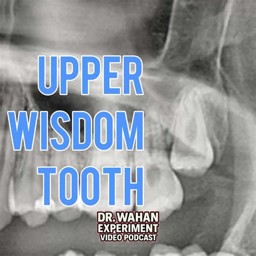 Upper Wisdom Tooth Extraction