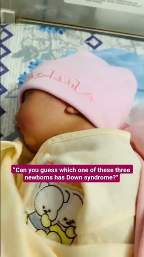 Can You Spot Down Syndrome in a Newborn? | Early Signs Every Parent Must Know#baby #views #shorts
